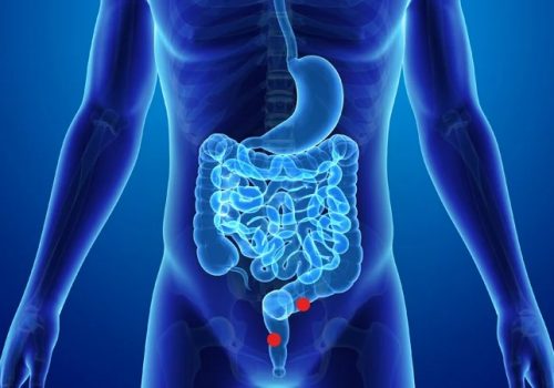 Cáncer de colon: causas, tipos, prevención y síntomas
