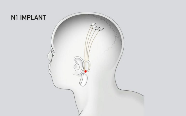 Neuralink obtiene aprobación para estudio clínico de implantes cerebrales en humanos