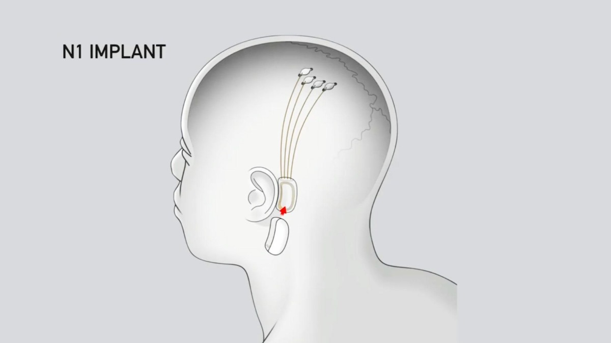 Neuralink obtiene aprobación para estudio clínico de implantes cerebrales en humanos